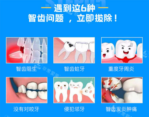 需要拔除的智齿情况