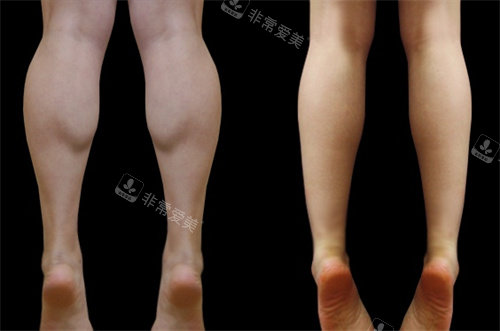 jelim整形外科小腿對(duì)比 jelim整形外科小腿對(duì)比
