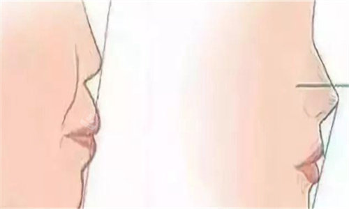 隆鼻前后側(cè)面對(duì)比