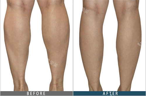 韩国JELIM整形腿型矫正手术前后对比图