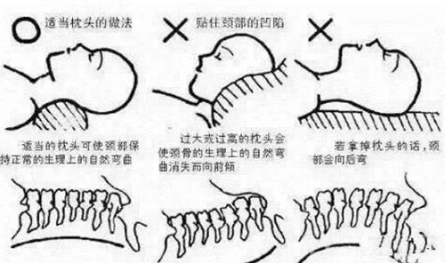 不良的姿势导致富贵包