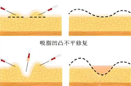 吸脂術(shù)后皮膚凹凸不平