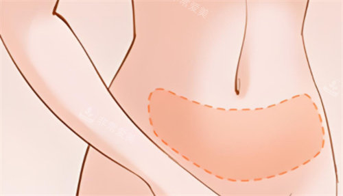 吸脂腹部区域