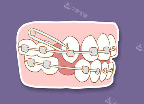 牙齿收缝卡通图片111