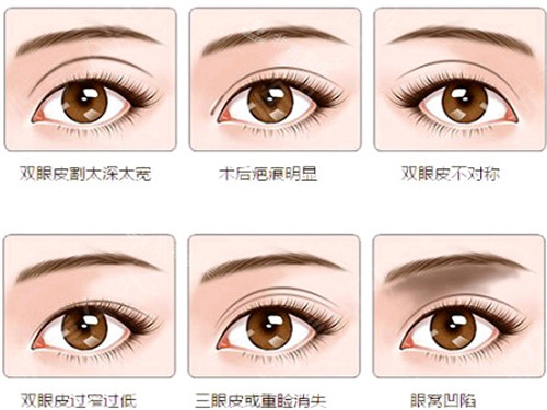 不同需要進(jìn)行修復(fù)的雙眼皮