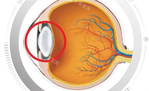白内障的眼球