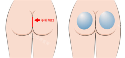 假体丰臀手术切口