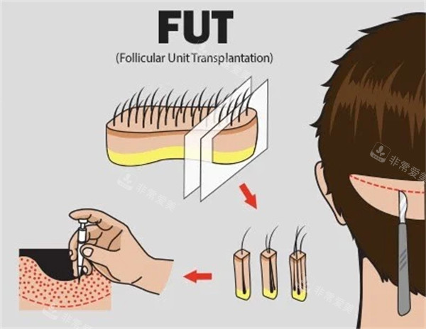 FUT植发技术手术过程图解