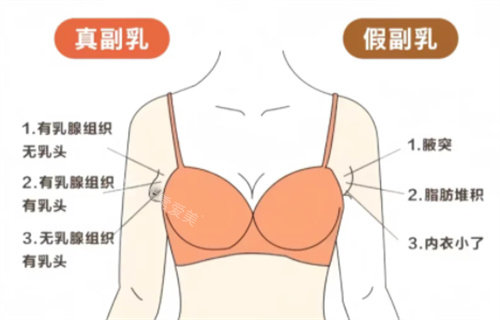 真假性副乳对比