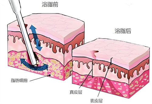 射频溶脂术皮肤层