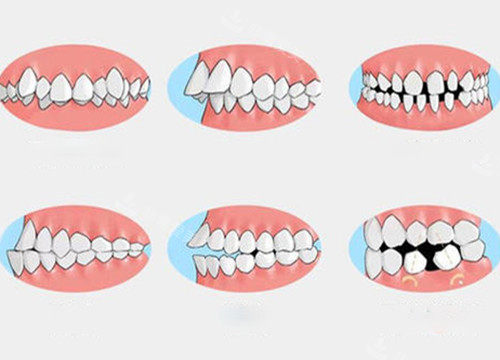 需要牙齿矫正的问题