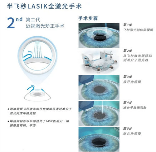 半飞秒手术示意图