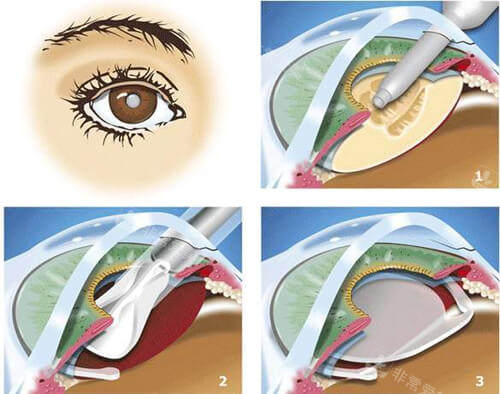 icl晶体植入手术过程漫画图
