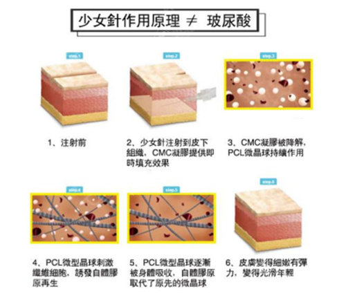 少女针和玻尿酸的对比