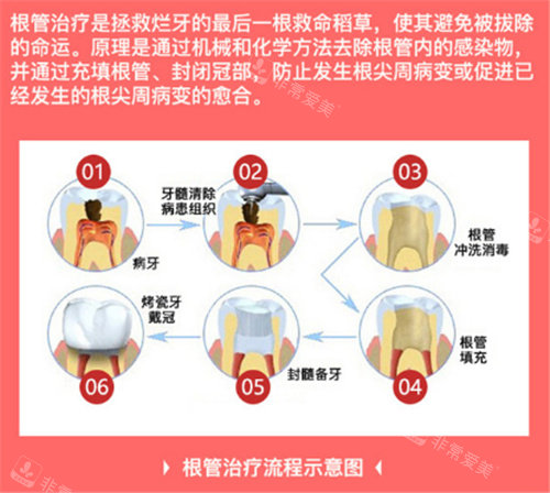 根管治疗流程展示