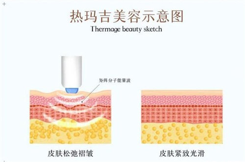 热玛吉工作示意图