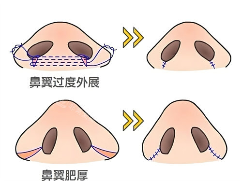 鼻翼缩小手术方式动画图