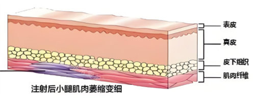 注射瘦腿原理