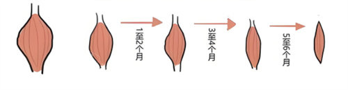 注射瘦腿肌肉缩小