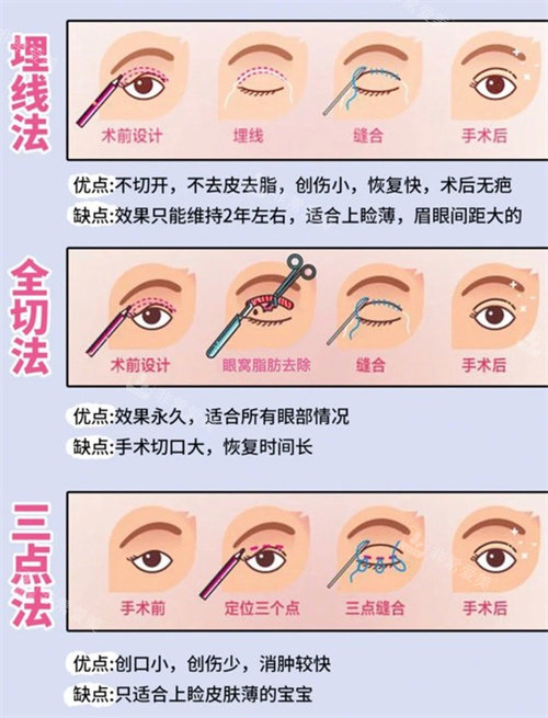 双眼皮三种手术方式动画