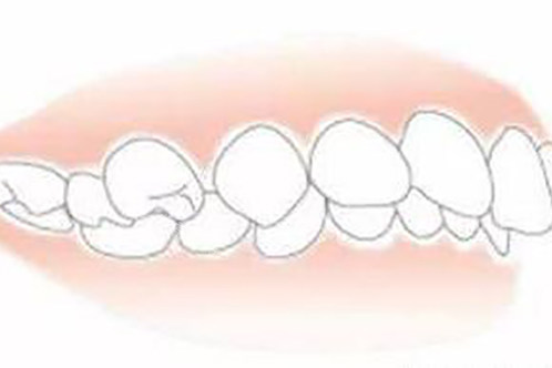 需要牙齿矫正的状态示意图