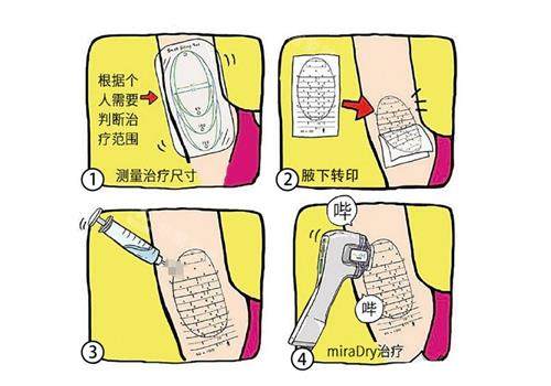 miradry微波治疗的过程图