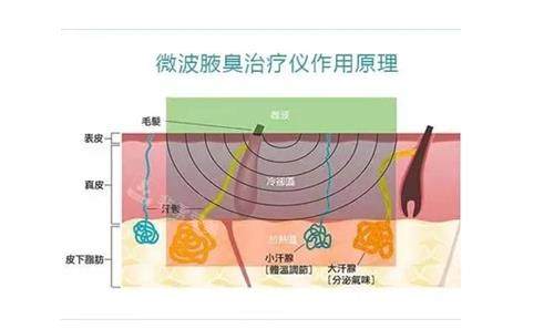 miradry微波治疗原理