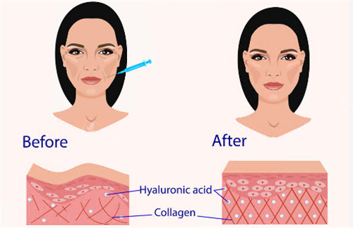 玻尿酸注射前后对比