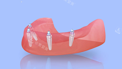 半口种植牙四颗植体植入漫画图