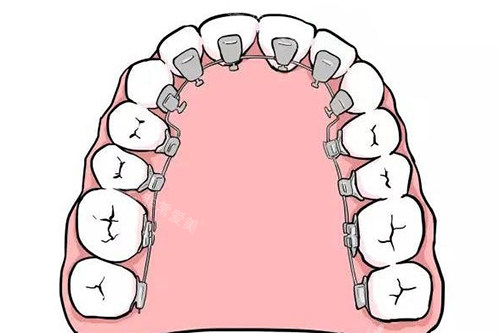 舌侧矫正器卡通示意图