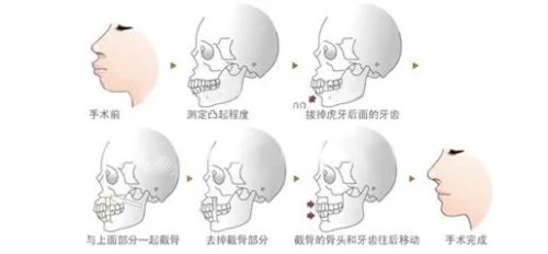 正颌手术步骤图示