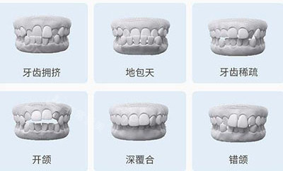 六种不同类型牙齿矫正适应症 六种不同类型牙齿矫正适应症