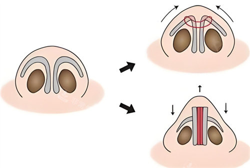 鼻头缩小原理
