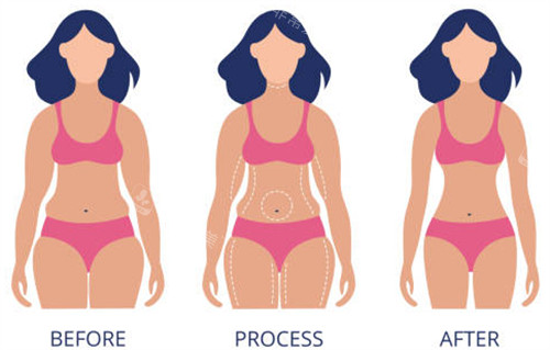 瘦身针前后体型过程对比