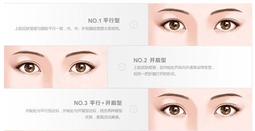 韩国双眼皮经验贴！去韩国江南做自然粘连双眼皮手术五个月还这么美！！