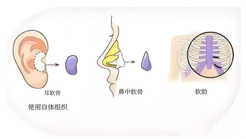 隆鼻耳中隔软骨体移植手术动画演示图