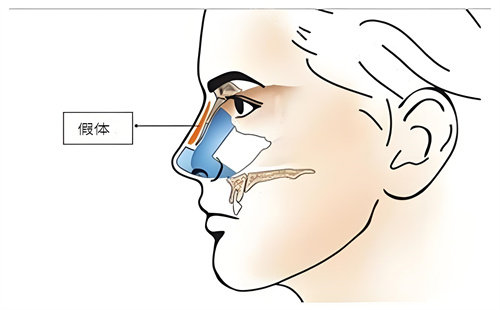 硅胶假体隆鼻手术