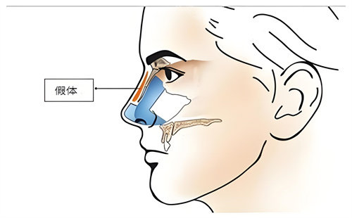 硅膠假體隆鼻手術(shù)