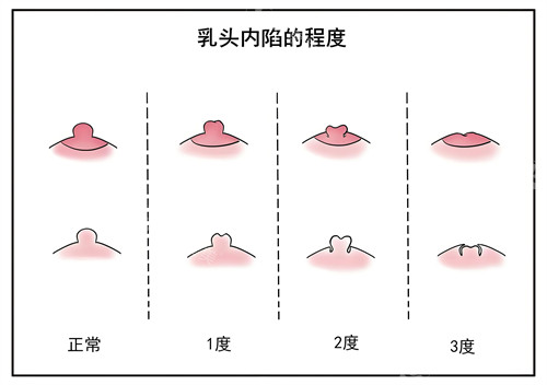 乳頭內(nèi)陷的程度演示圖