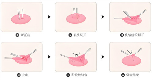 乳頭內(nèi)陷手術(shù)步驟圖解