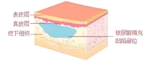 玻尿酸填充凹陷