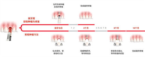 种植牙即刻种植过程图解