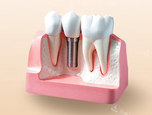 种植牙模型图示