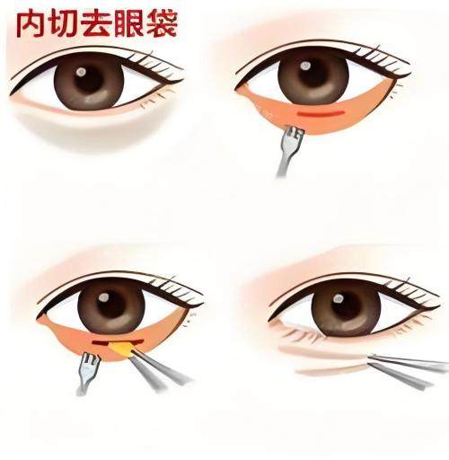 內(nèi)切去眼袋演示動畫圖