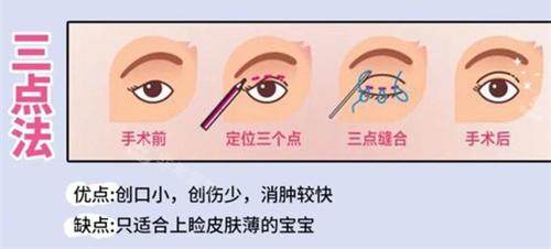 双眼皮手术三点法动画演示图