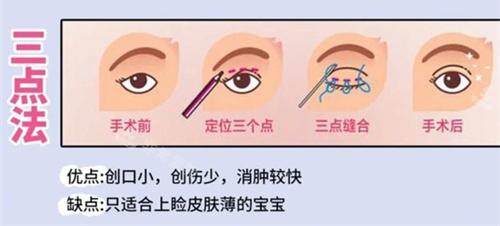 雙眼皮手術(shù)三點(diǎn)法動(dòng)畫演示圖