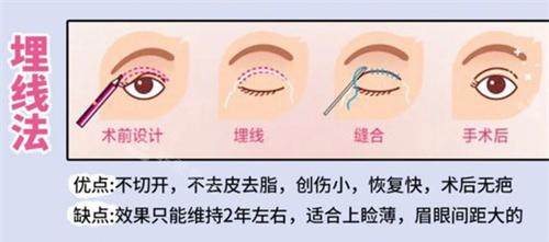 雙眼皮手術(shù)埋線法動(dòng)畫演示圖