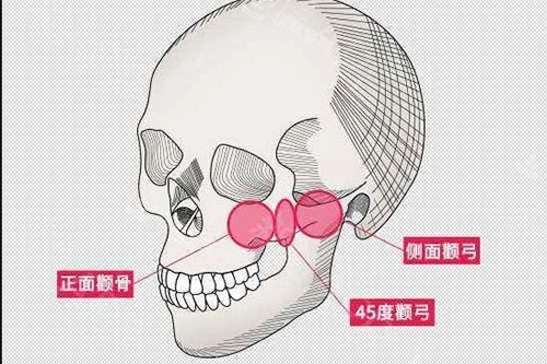 顴骨顴弓大概位置示意圖 顴骨顴弓大概位置示意圖