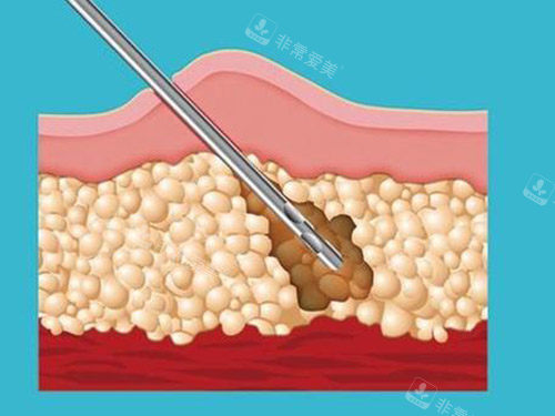 吸脂针图片