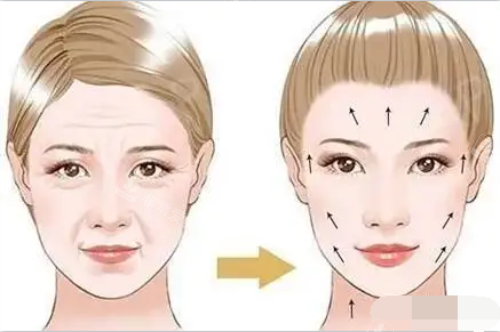​去韩国做了面部提升手术，法令纹不见了皮肤变得特别紧致！